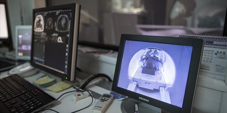 İnme rahatsızlıklarında beyne pıhtı atılması "şapka yöntemi"yle ameliyatsız önlenebiliyor