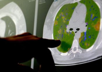 Kovid-19 virüsünün beyin hücreleriyle birleşebildiği kanıtlandı