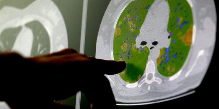 Kovid-19 virüsünün beyin hücreleriyle birleşebildiği kanıtlandı