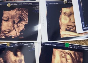 Çoğul gebelik oranları Kovid-19 sonrası dünya genelinde artışa geçti