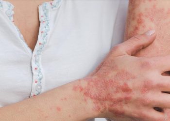 Gül hastalığı kadınlar ve açık tenlilerde daha çok görülüyor