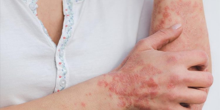 Gül hastalığı kadınlar ve açık tenlilerde daha çok görülüyor