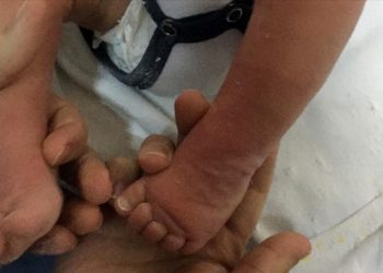 Doğuştan çarpık ayak, kararlı tedaviyle normale dönebiliyor