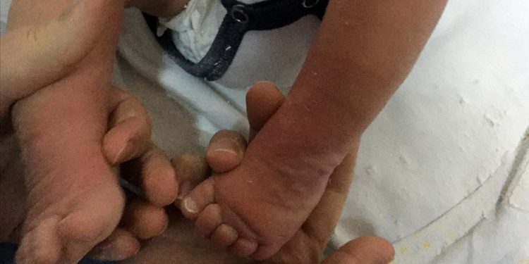 Doğuştan çarpık ayak, kararlı tedaviyle normale dönebiliyor