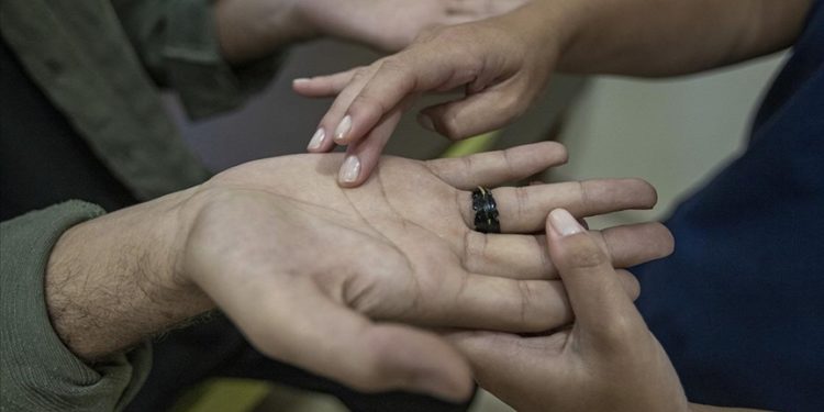 Sosyal hayatı etkileyen el terlemesine 50 dakikalık müdahaleyle kalıcı çözüm