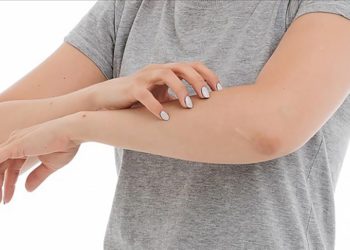 Uzmanlardan kronik ürtiker hastalarına beslenme uyarısı