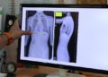 Çocuklarda ergenlik öncesi skolyoz kontrolü tedavi şansını artırıyor