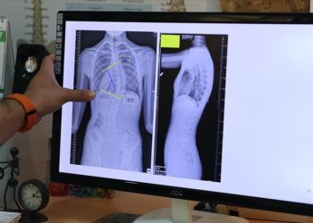 Çocuklarda ergenlik öncesi skolyoz kontrolü tedavi şansını artırıyor