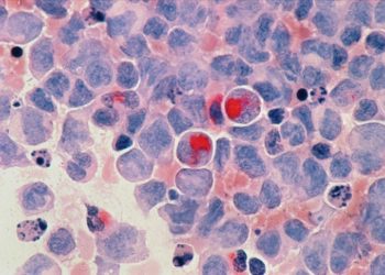 Lenf kanserleri ve akut lösemilerde erken tedavi önem taşıyor