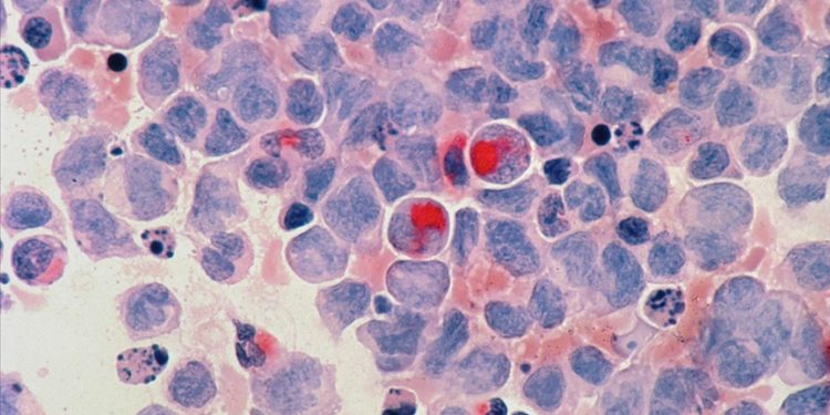 Lenf kanserleri ve akut lösemilerde erken tedavi önem taşıyor