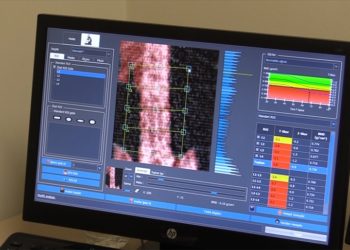 Kadınlarda kemik kırıklarının nedeni osteoporoz polikliniğinde araştırılıyor