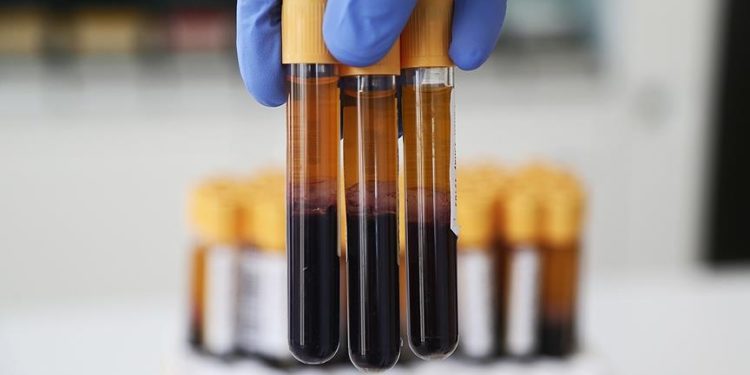 Kan testiyle hızlı ve yavaş yaşlanan organlar tespit edilebilir