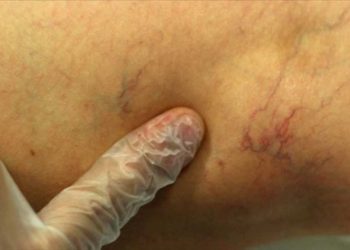 Önemsenmeyen bacak varisleri kalıcı hasarlara neden olabiliyor