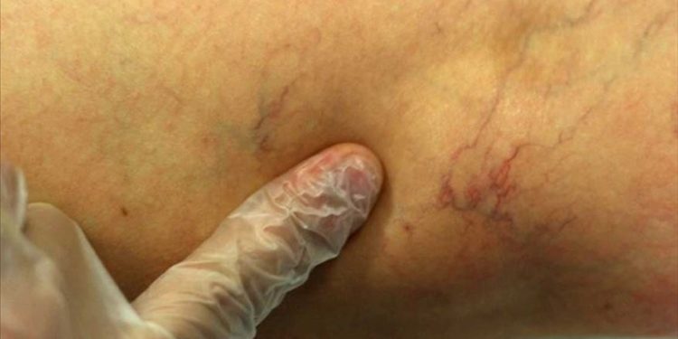 Önemsenmeyen bacak varisleri kalıcı hasarlara neden olabiliyor