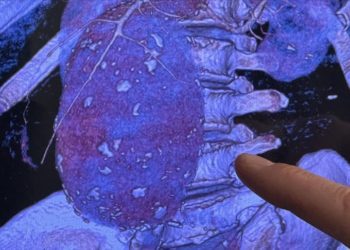 Aort damarı 11 santimetreye çıkıp patlayan hasta sağlığına kavuşturuldu