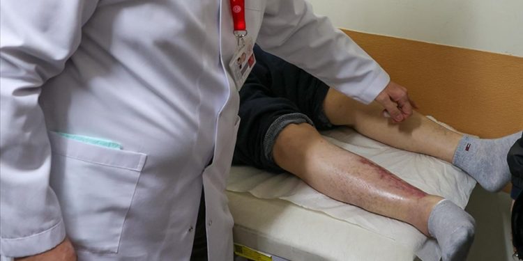 Kapanmayan yaralarından kök hücre tedavisiyle kurtuldu