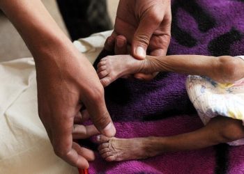 “Dünya Nadir Hastalıklar Günü” bu yıl, yılın en nadir gününde kutlanıyor