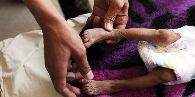 “Dünya Nadir Hastalıklar Günü” bu yıl, yılın en nadir gününde kutlanıyor