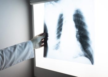 Dünyada erkeklerde en sık “akciğer”, kadınlarda da “meme kanseri” görülüyor