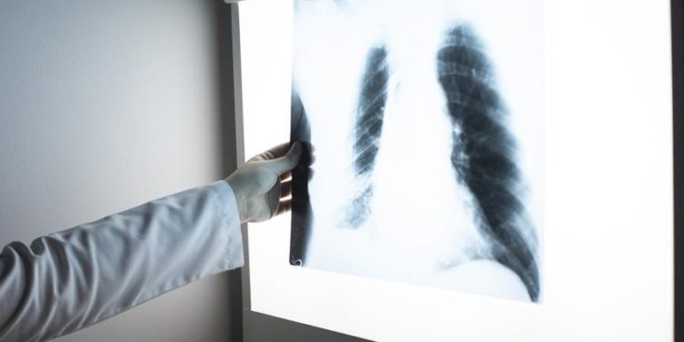 Dünyada erkeklerde en sık “akciğer”, kadınlarda da “meme kanseri” görülüyor