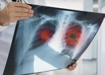 Erken tanı ve yeni tedavilerle kansere bağlı ölüm oranları azalıyor