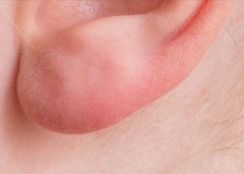 Kulak memesindeki çizgi, kalp-damar hastalığı riskine işaret edebilir