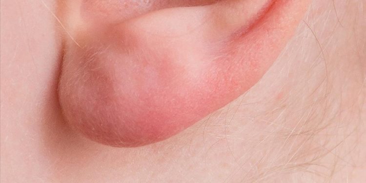 Kulak memesindeki çizgi, kalp-damar hastalığı riskine işaret edebilir