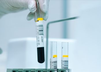 Talasemide geç tedavi en sık kalp hastalığından ölüme neden oluyor