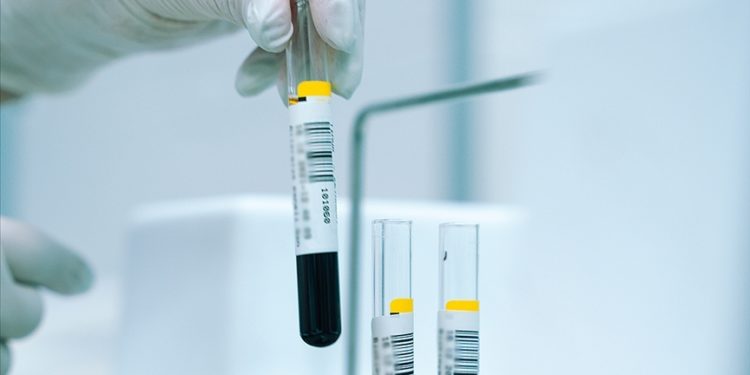 Talasemide geç tedavi en sık kalp hastalığından ölüme neden oluyor