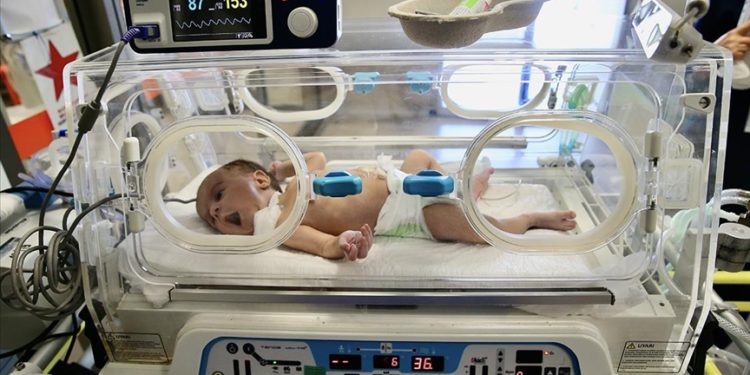 Yemek borusu oluşmadan doğan 2 aylık bebek, midesine takılan tüple besleniyor