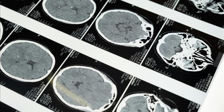 Yeni yapay zeka yazılımıyla inmenin geçirilme zamanı 2 kat daha doğru belirlenebiliyor