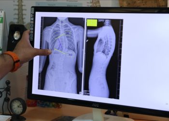 Yüzde 80’i ergenlikte ortaya çıkan skolyozun erken tanısı için ailelere uyarı