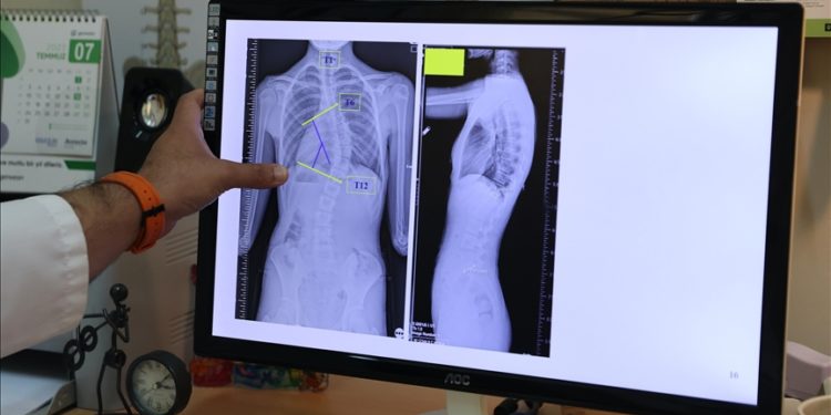 Yüzde 80’i ergenlikte ortaya çıkan skolyozun erken tanısı için ailelere uyarı